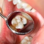close-up of a human rotten carious tooth at the treatment stage in a dental clinic. The use of rubber dam system with latex scarves and metal clips, production of photopolymeric composite fillings