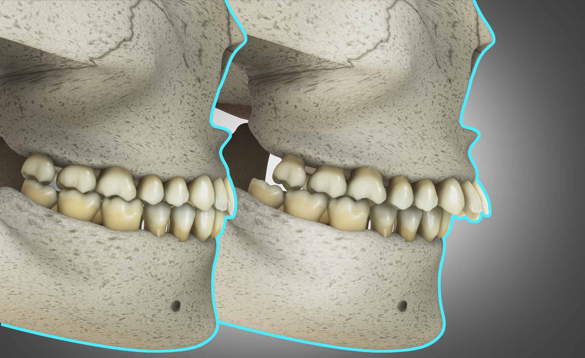 正常な歯ならびと出っ歯を比較する模型のイメージ