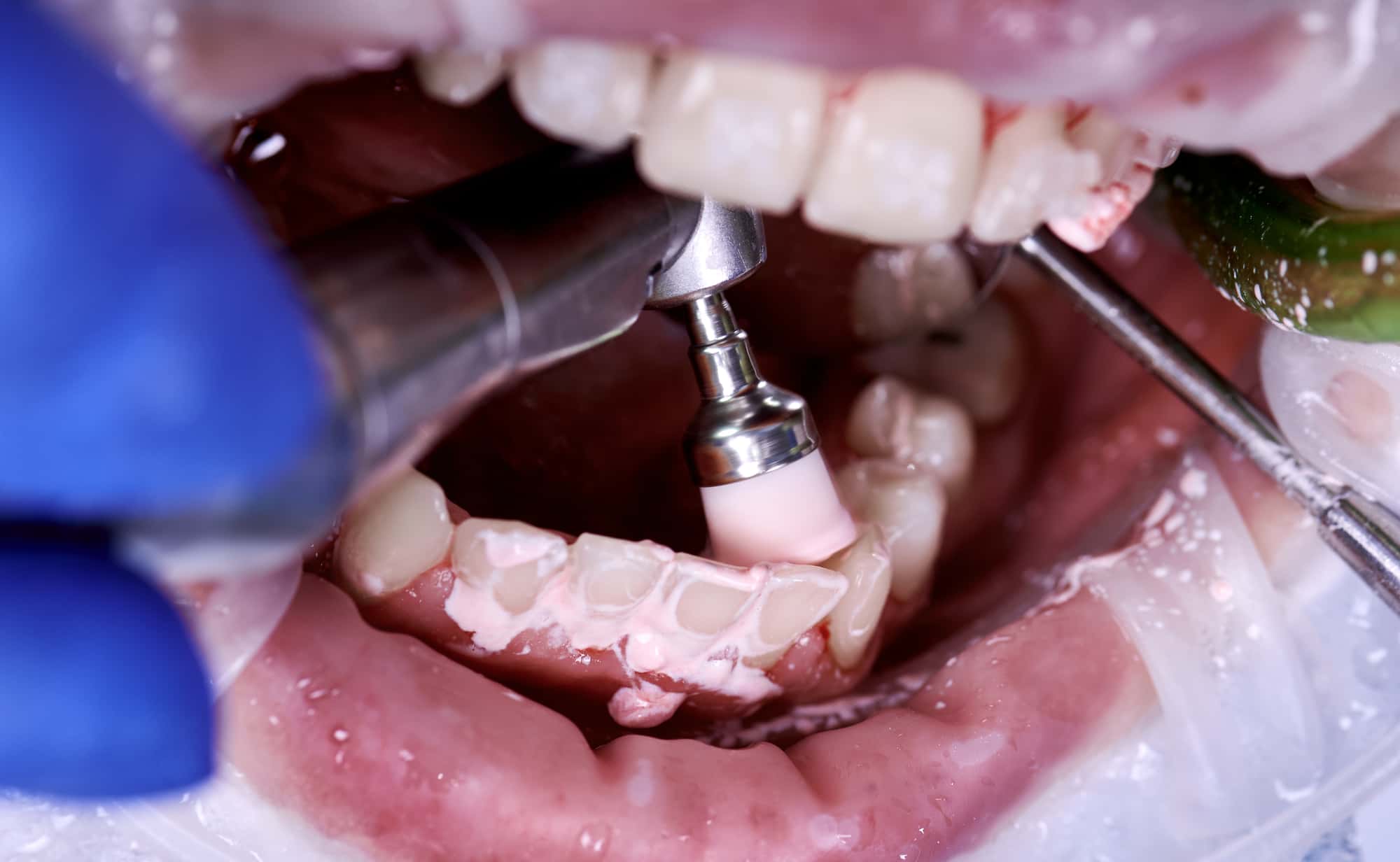 歯周病の進行を抑えるために歯科医院でクリーニングを受けるイメージ